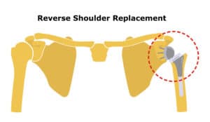 Reverse Shoulder Replacement. Shoulder joint replacement, endoprosthetics. Osteoarthrosis of the shoulder joint. Vector illustration. Flat design.