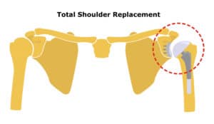 Total Shoulder Replacement. Shoulder joint replacement, endoprosthetics. Osteoarthrosis of the shoulder joint. Vector illustration. Flat design.
